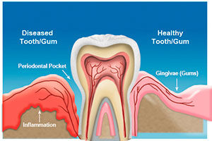 Teeth Straightening Treatment