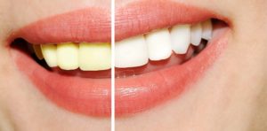 A Complete Guide to Teeth Whitening Options