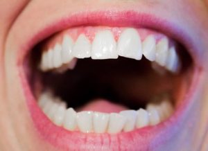 A Complete Guide to Teeth Whitening Options
